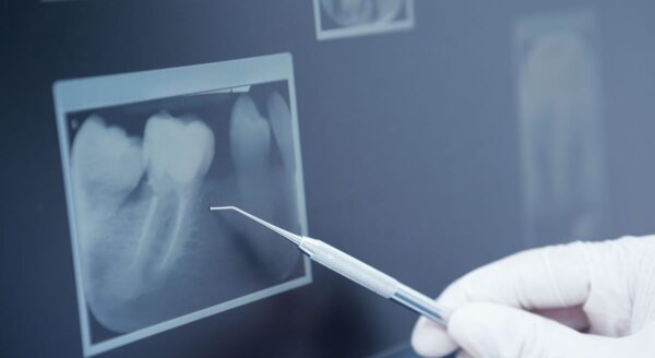 Hairline Tooth Fractures (cracks)